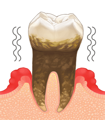 gumproblem